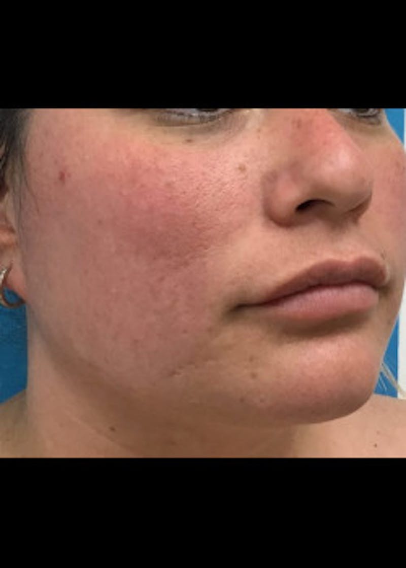 Jaw Contouring Before & After Gallery - Patient 46618842 - Image 5