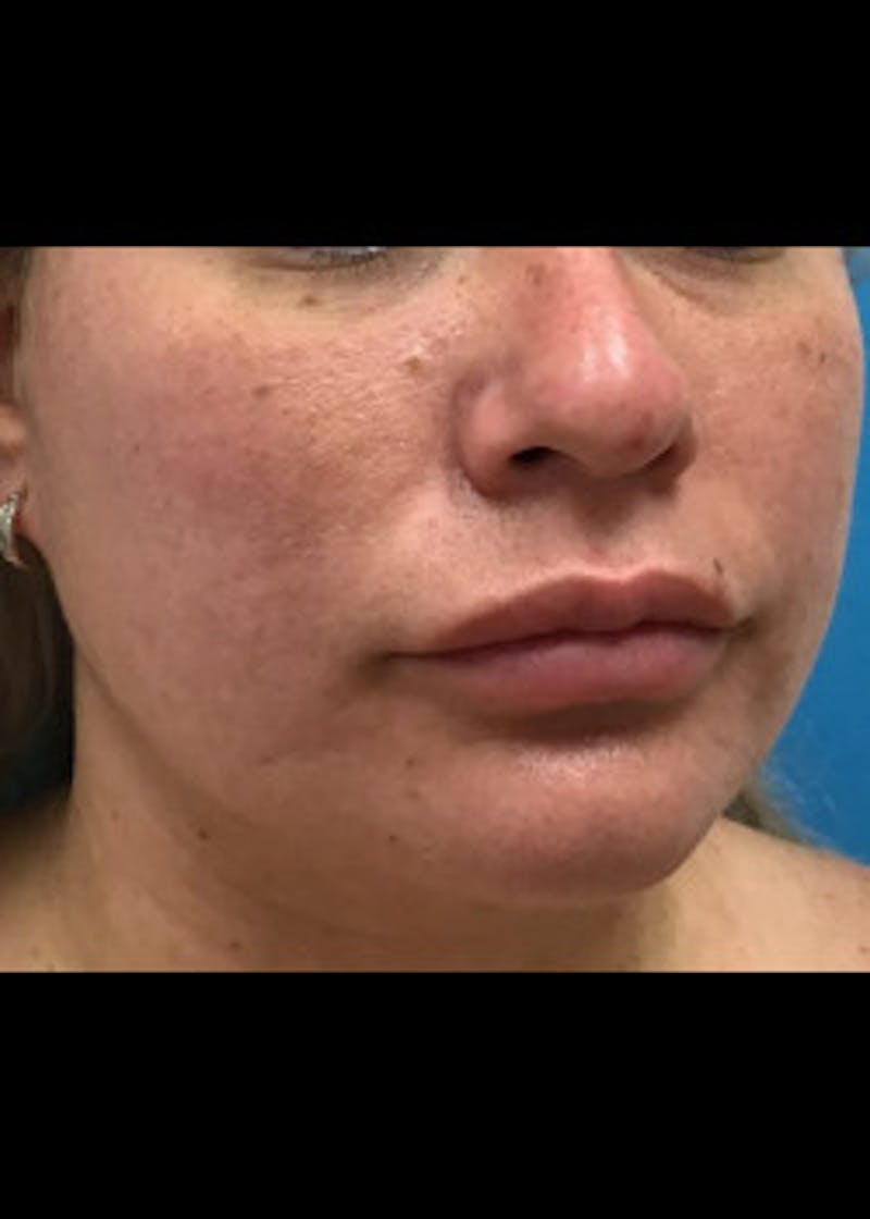 Jaw Contouring Before & After Gallery - Patient 46618842 - Image 6