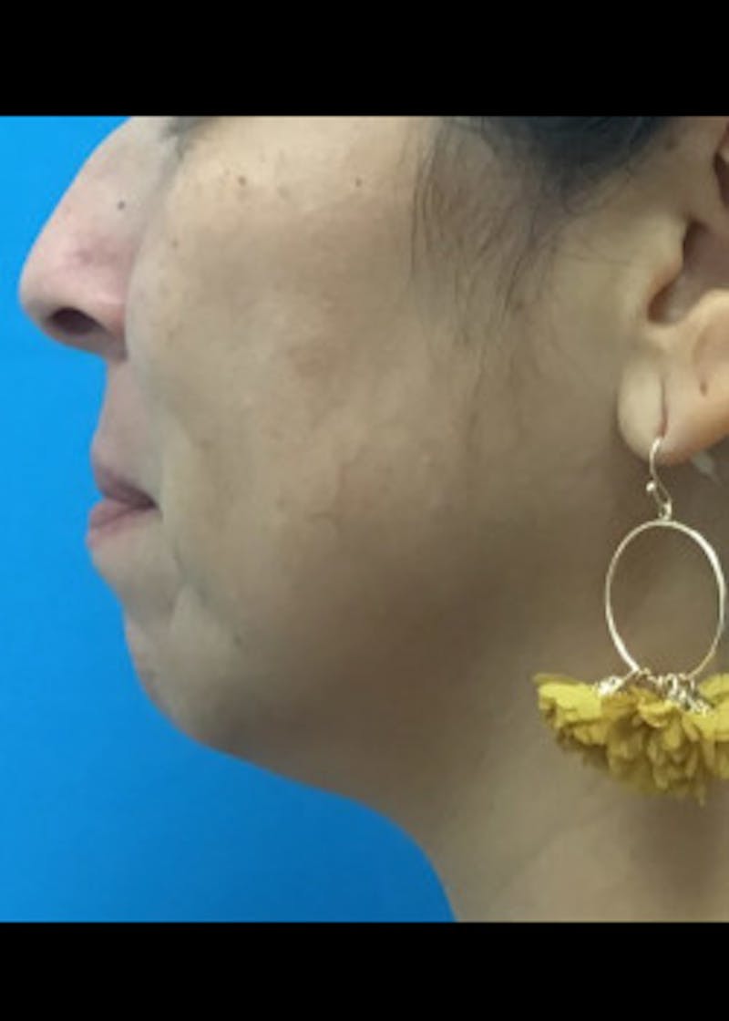 Jaw Contouring Before & After Gallery - Patient 46618893 - Image 1