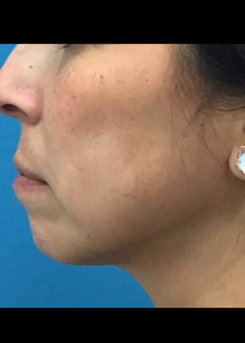 Jaw Contouring Before & After Gallery - Patient 46618893 - Image 2