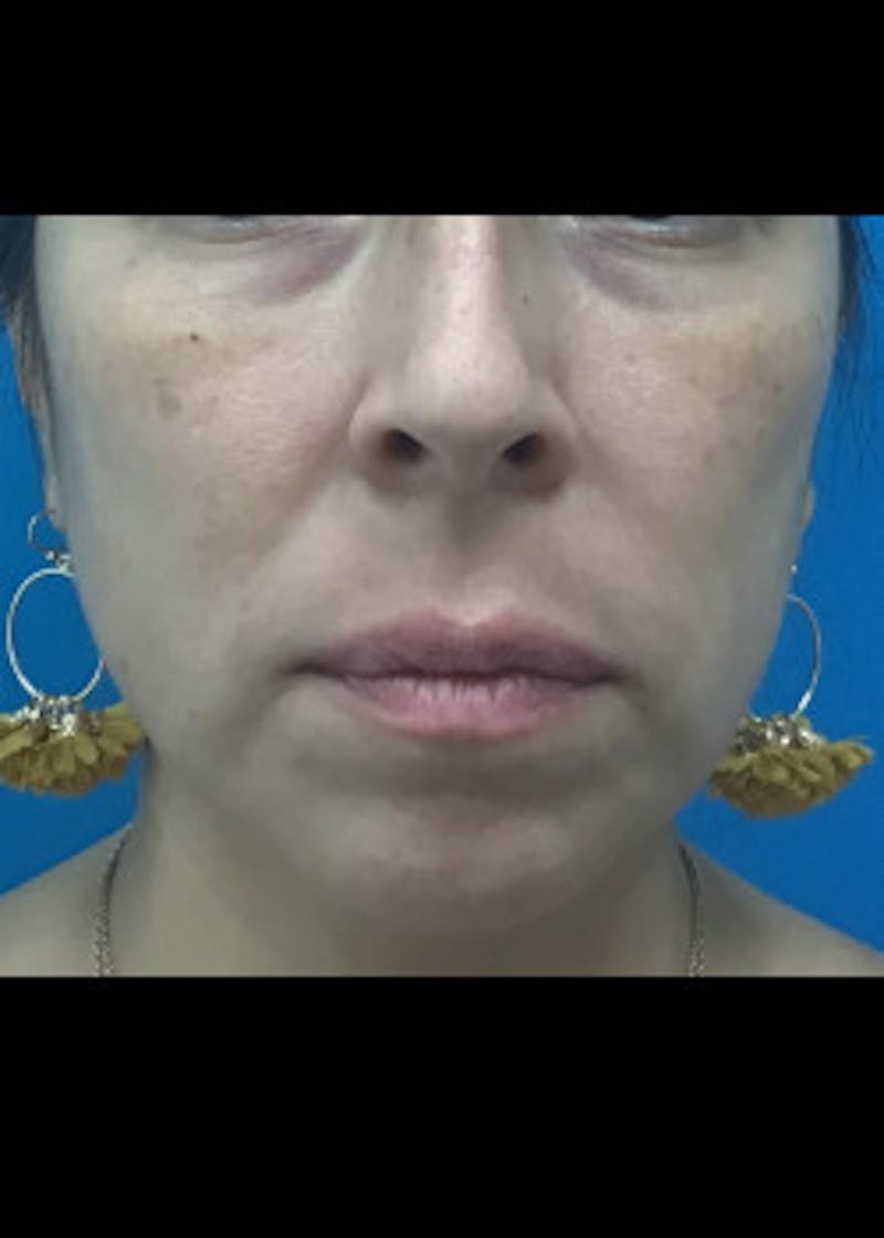 Jaw Contouring Before & After Gallery - Patient 46618893 - Image 3