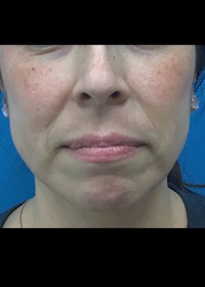 Jaw Contouring Before & After Gallery - Patient 46618893 - Image 2