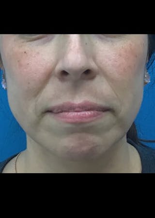 Jaw Contouring Before & After Gallery - Patient 46618893 - Image 2