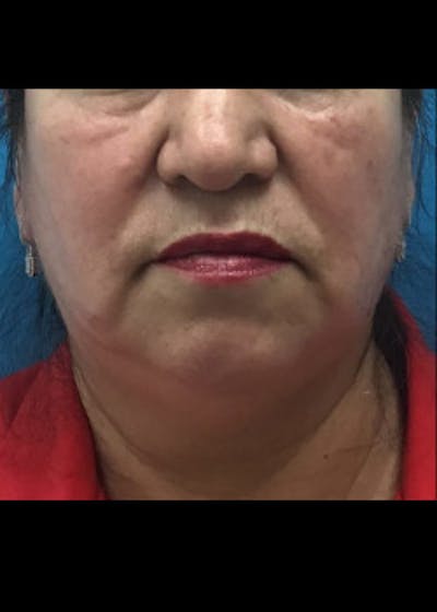 Neck Liposuction Before & After Gallery - Patient 46619042 - Image 1