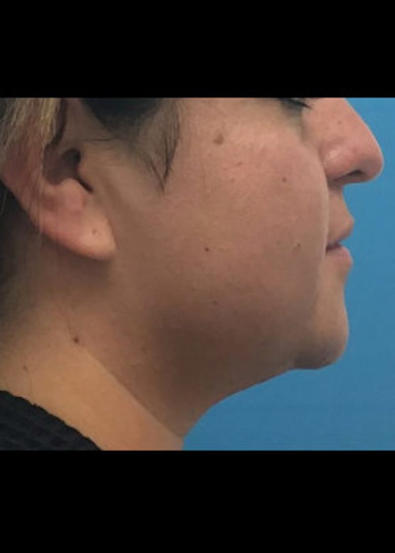 Neck Liposuction Before & After Gallery - Patient 46619061 - Image 1