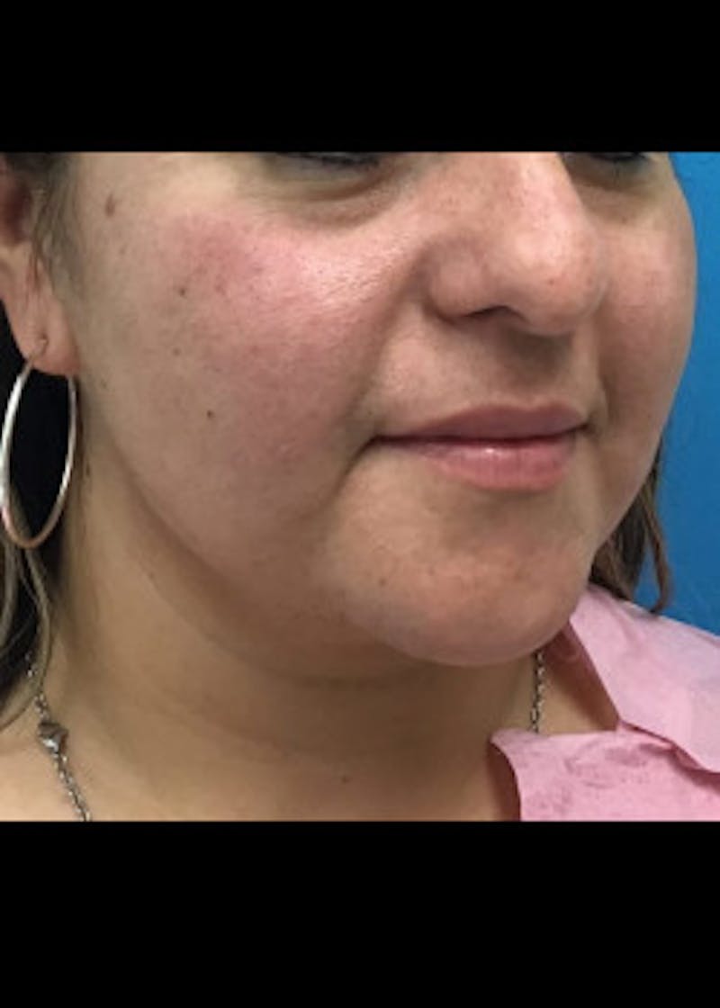 Neck Liposuction Before & After Gallery - Patient 46619061 - Image 4