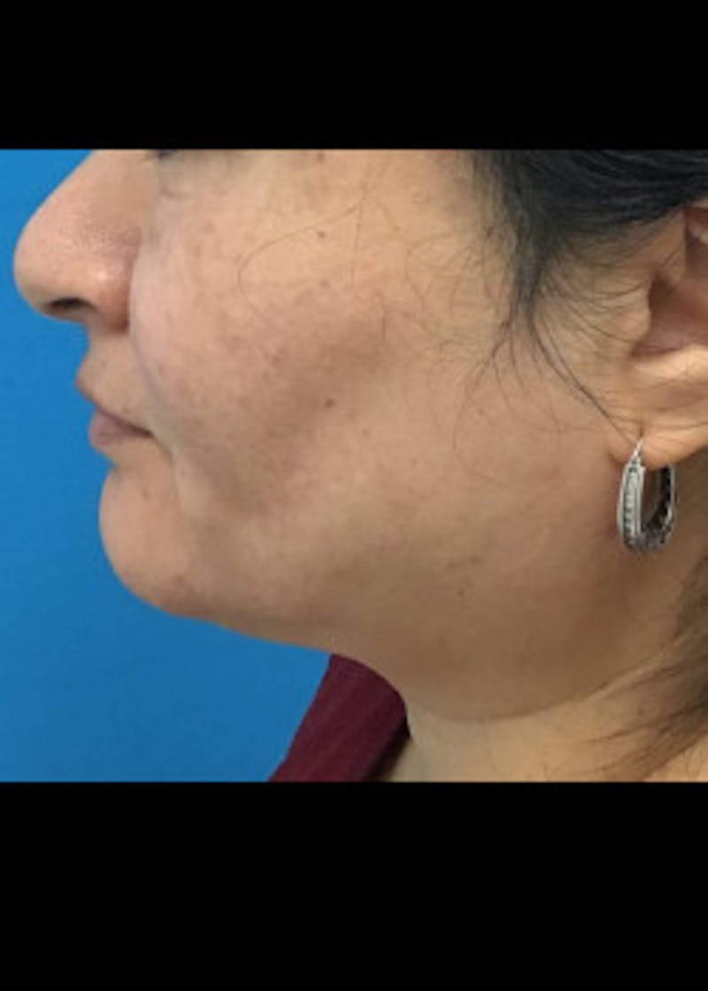 Neck Liposuction Before & After Gallery - Patient 46619068 - Image 1