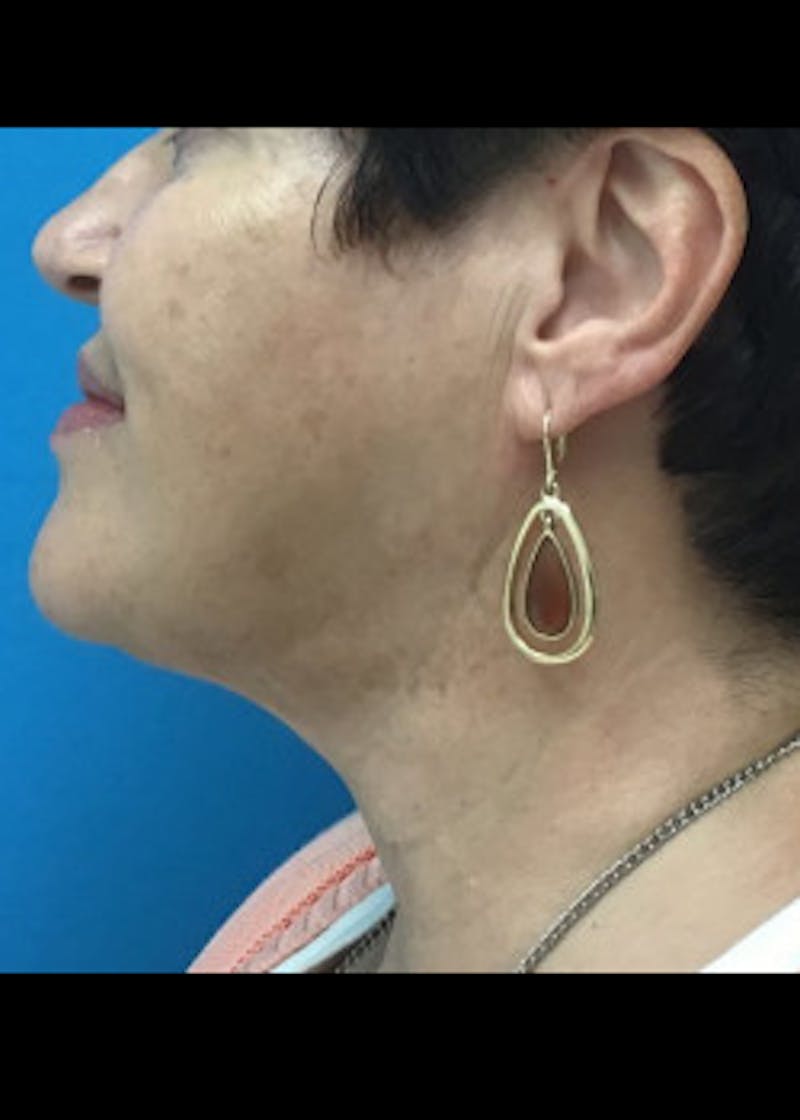 Neck Liposuction Before & After Gallery - Patient 46619098 - Image 2