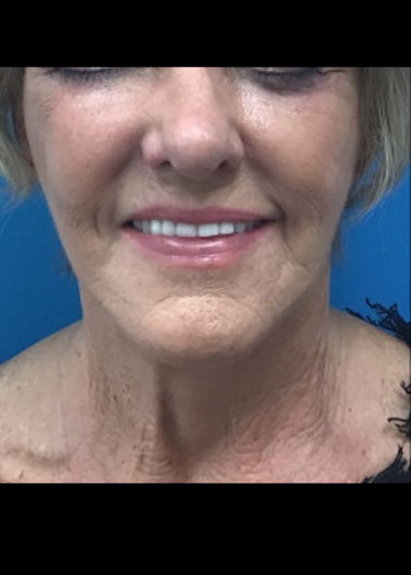 Neck Lift Before & After Gallery - Patient 46619139 - Image 4