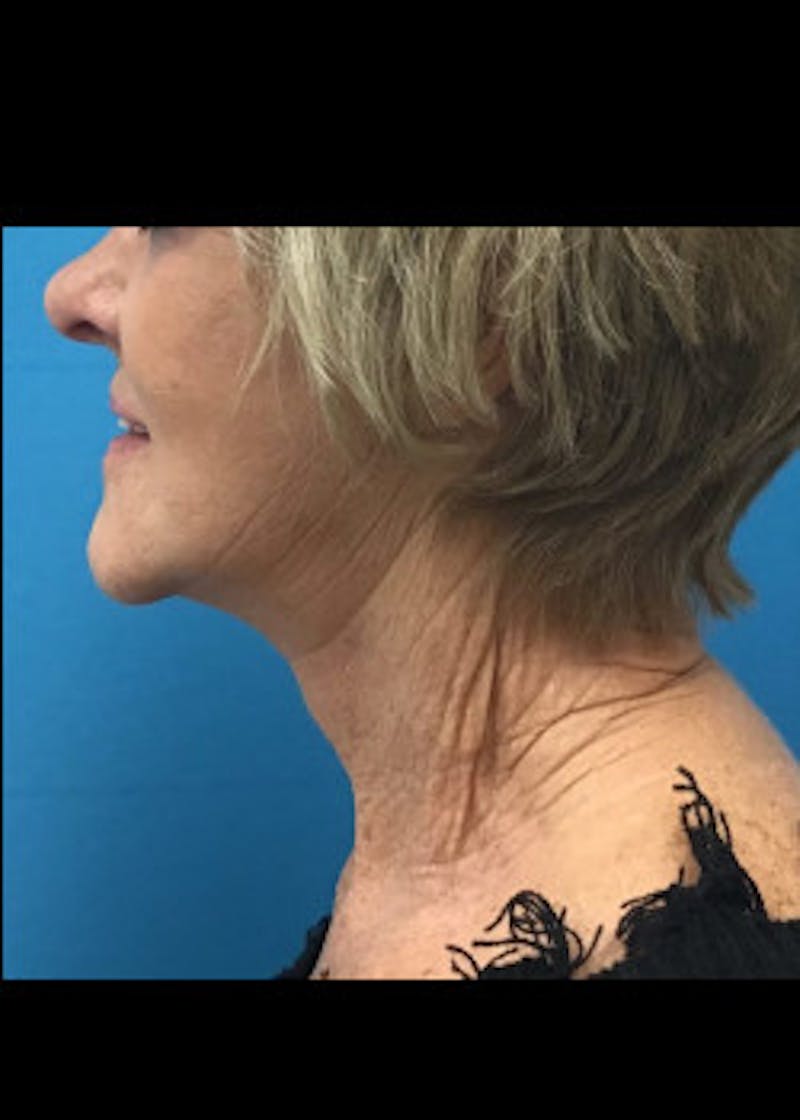 Neck Lift Before & After Gallery - Patient 46619139 - Image 6
