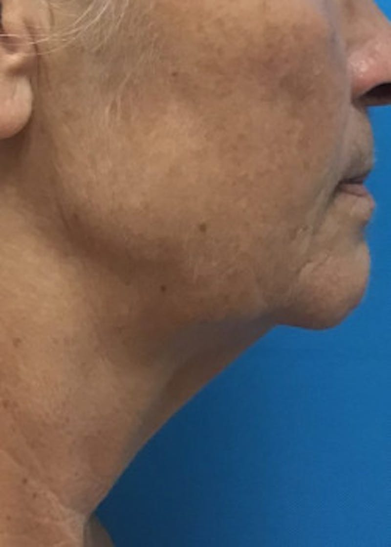 Neck Lift Before & After Gallery - Patient 46619149 - Image 1
