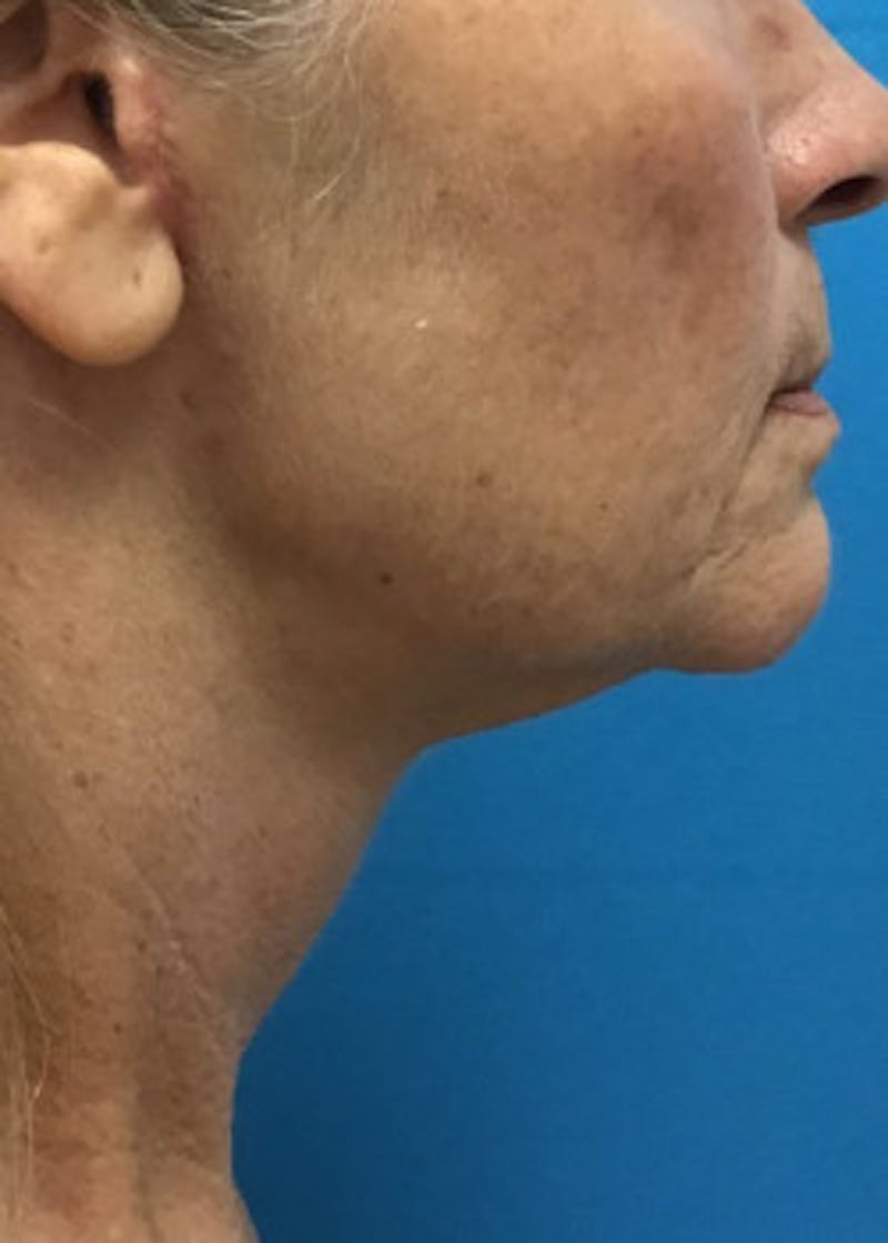 Neck Lift Before & After Gallery - Patient 46619149 - Image 2