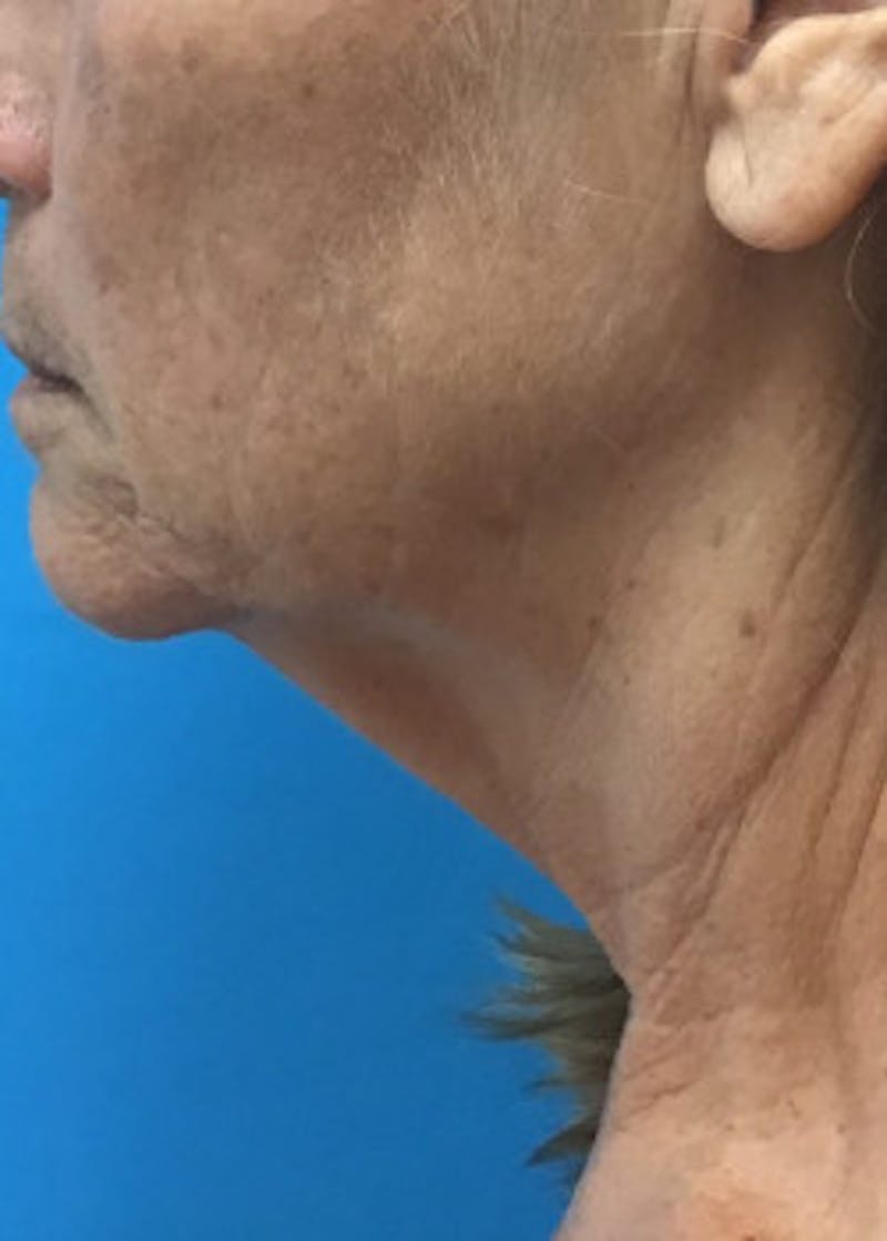 Neck Lift Before & After Gallery - Patient 46619149 - Image 3