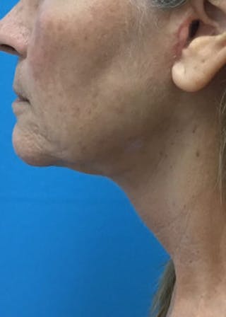 Neck Lift Before & After Gallery - Patient 46619149 - Image 4