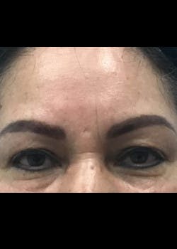 Eyelid Surgery