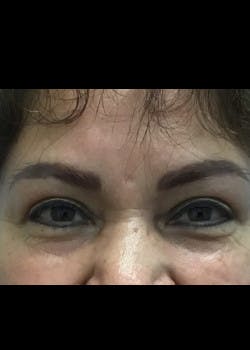 Eyelid Surgery