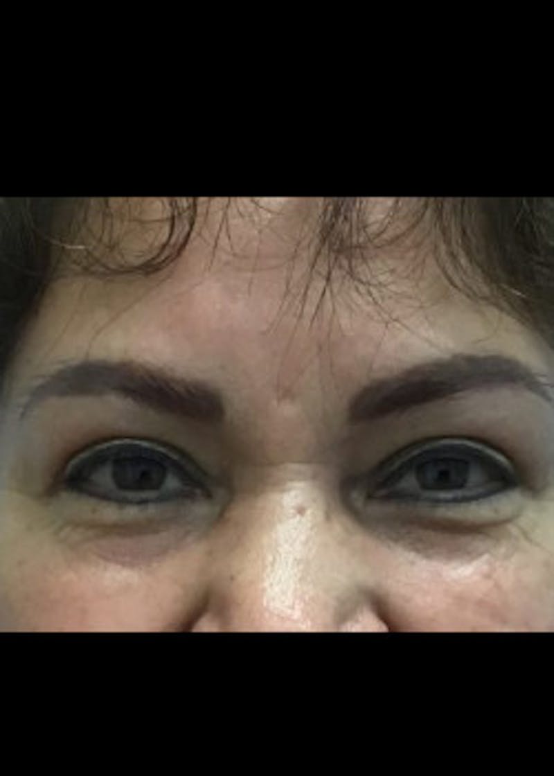 Eyelid Surgery Before & After Gallery - Patient 46619594 - Image 2