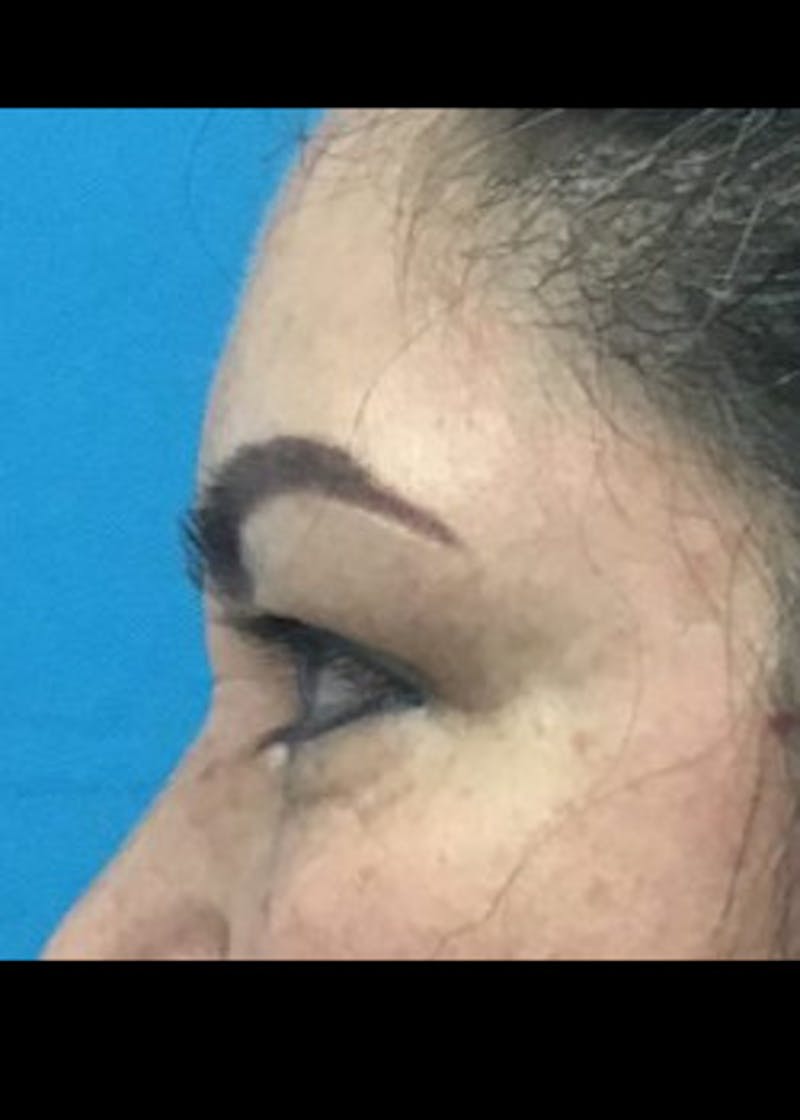 Eyelid Surgery Before & After Gallery - Patient 46619594 - Image 3