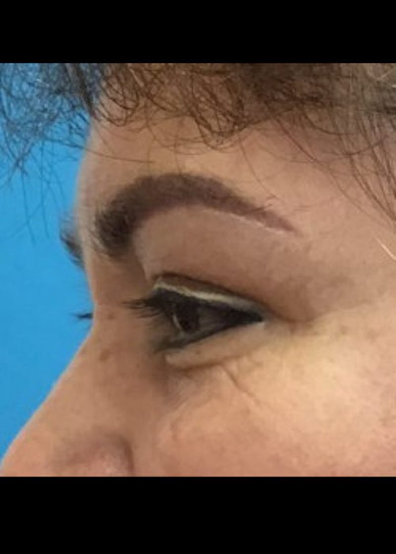 Eyelid Surgery Before & After Gallery - Patient 46619594 - Image 4