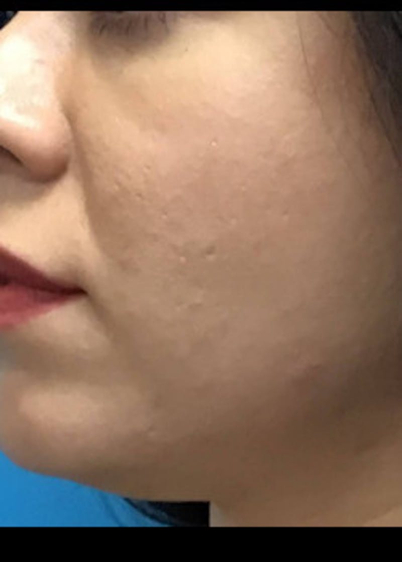 Fillers Before & After Gallery - Patient 46619710 - Image 1