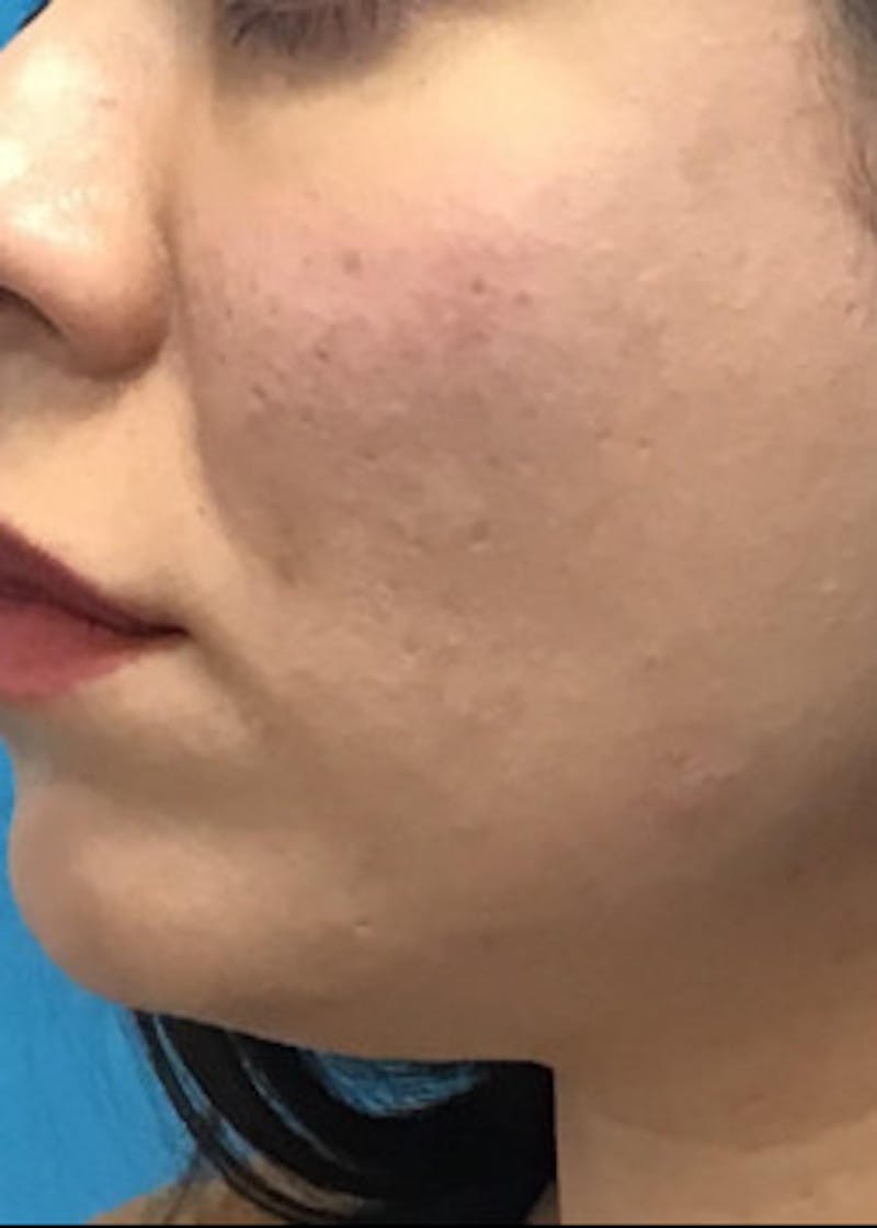 Fillers Before & After Gallery - Patient 46619710 - Image 2