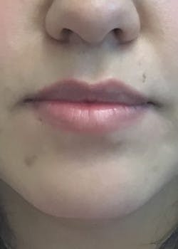Dermal Fillers