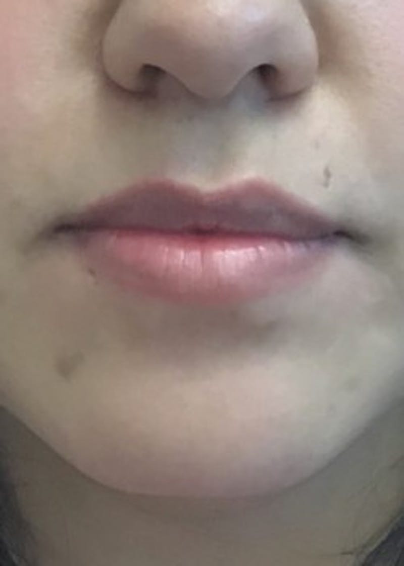 Fillers Before & After Gallery - Patient 46619756 - Image 1