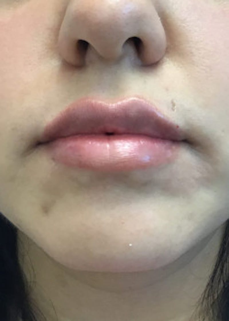 Fillers Before & After Gallery - Patient 46619756 - Image 2