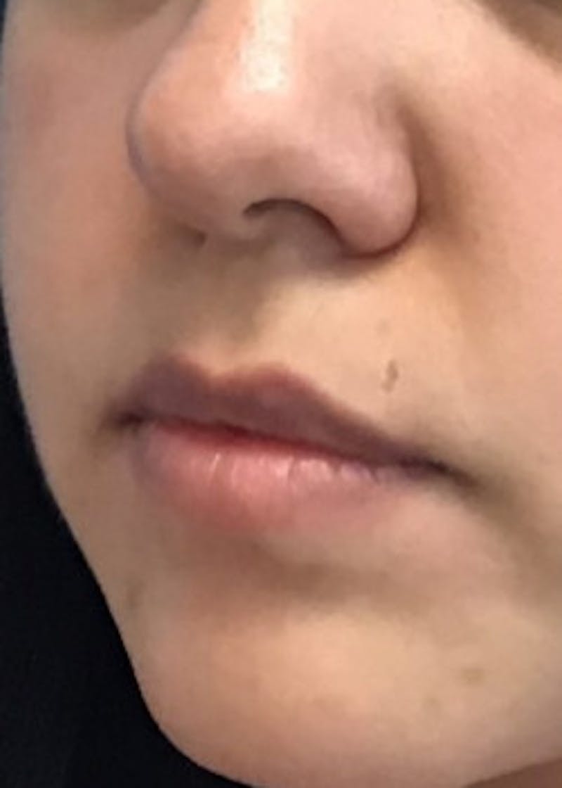 Fillers Before & After Gallery - Patient 46619756 - Image 3