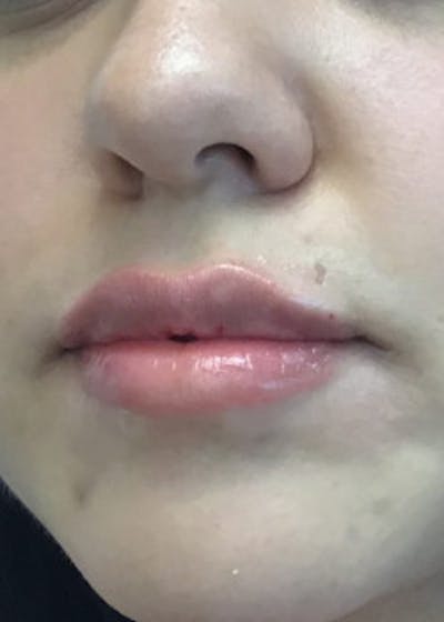 Med Spa Friendswoods & League City Patient Before & After Photo