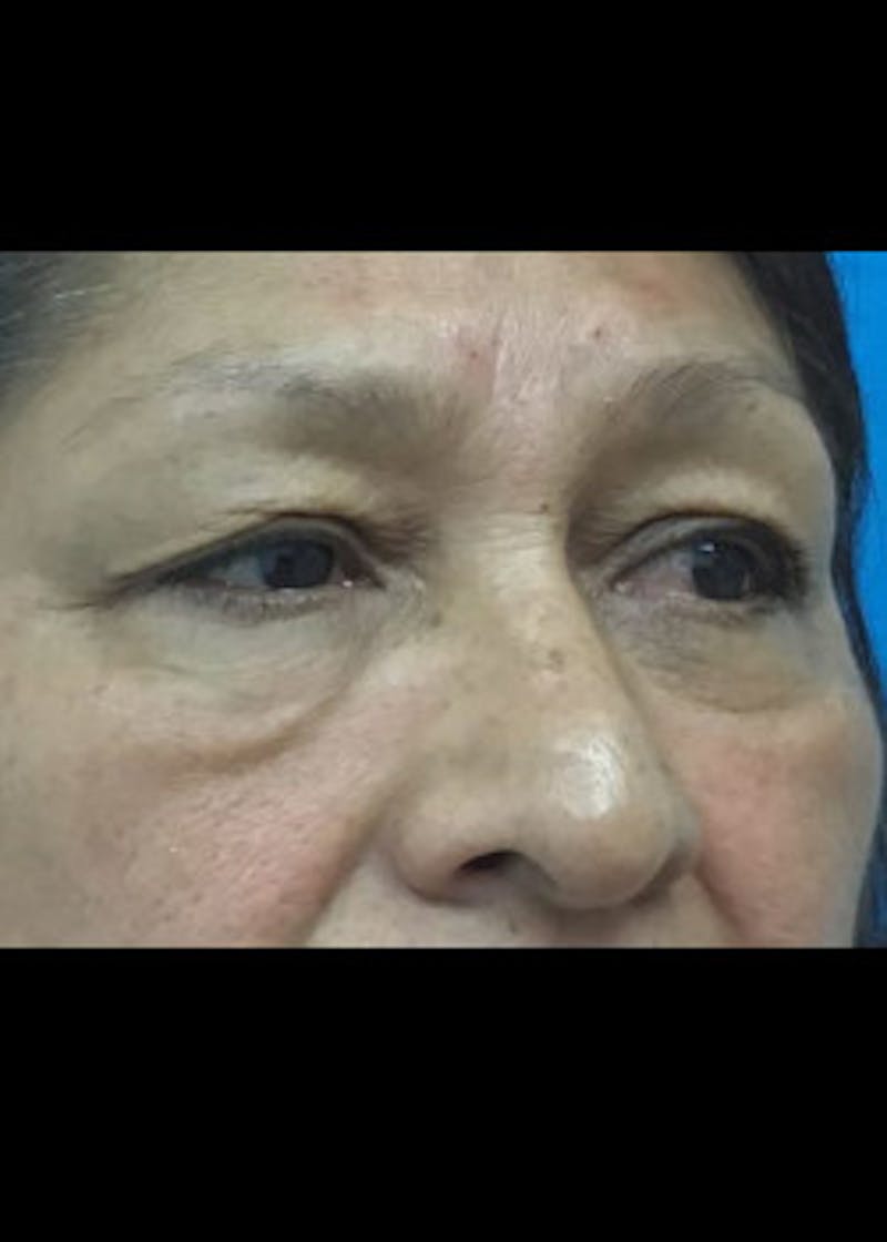 Fillers Before & After Gallery - Patient 46619790 - Image 1