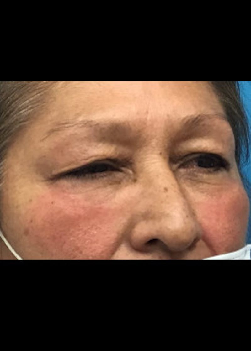 Fillers Before & After Gallery - Patient 46619790 - Image 2