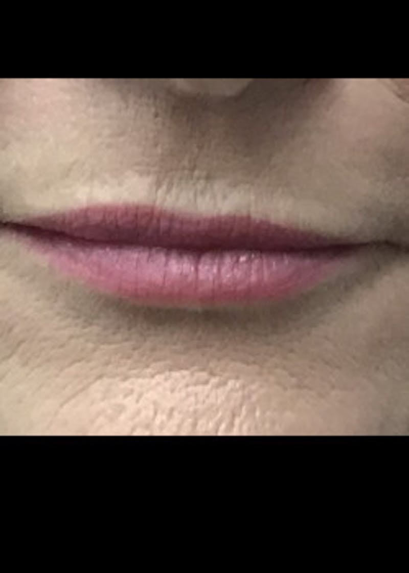 Fillers Before & After Gallery - Patient 46619809 - Image 1