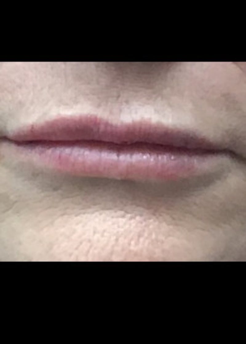 Fillers Before & After Gallery - Patient 46619809 - Image 2