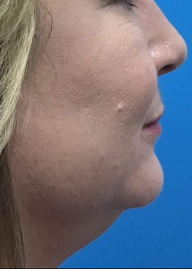 Fillers Before & After Gallery - Patient 46619870 - Image 1