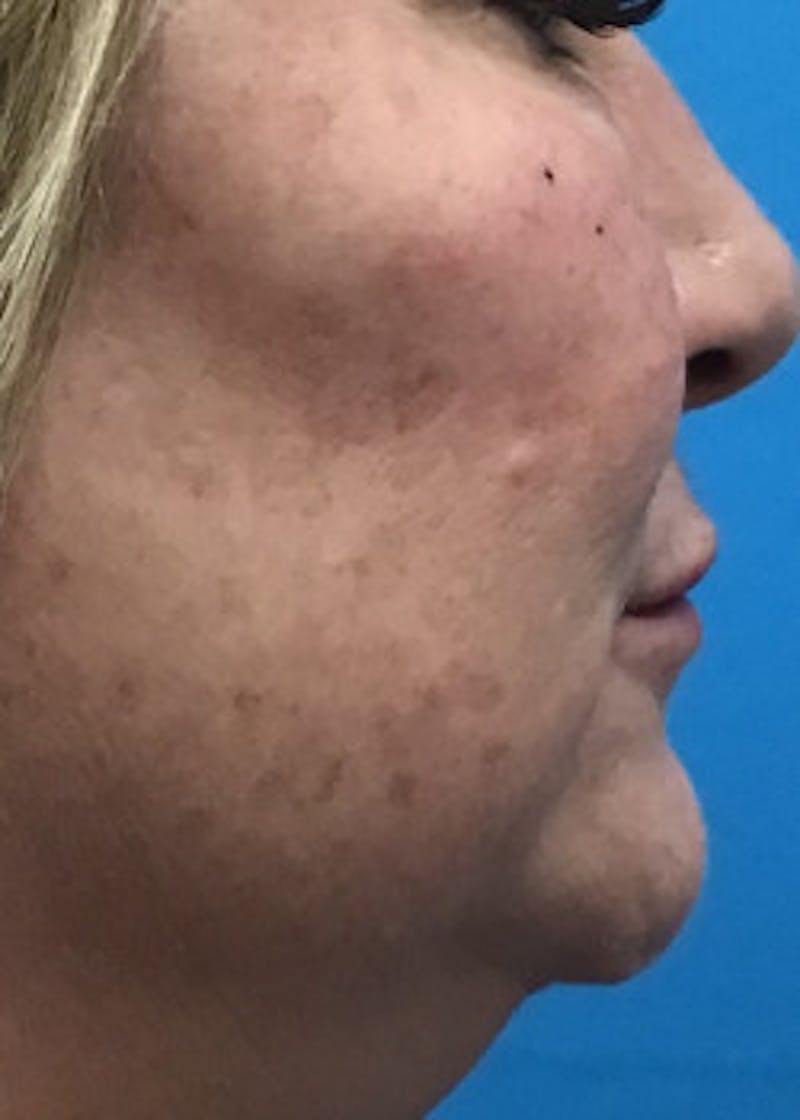 Fillers Before & After Gallery - Patient 46619870 - Image 2