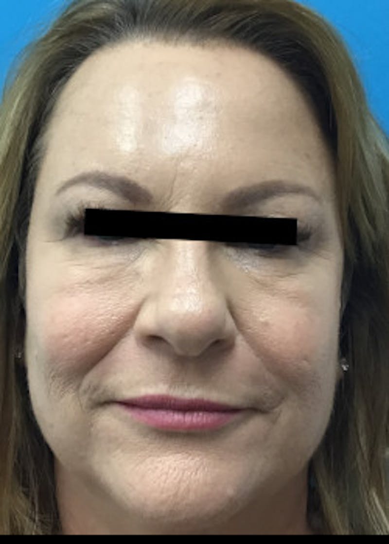 Fillers Before & After Gallery - Patient 46619870 - Image 3