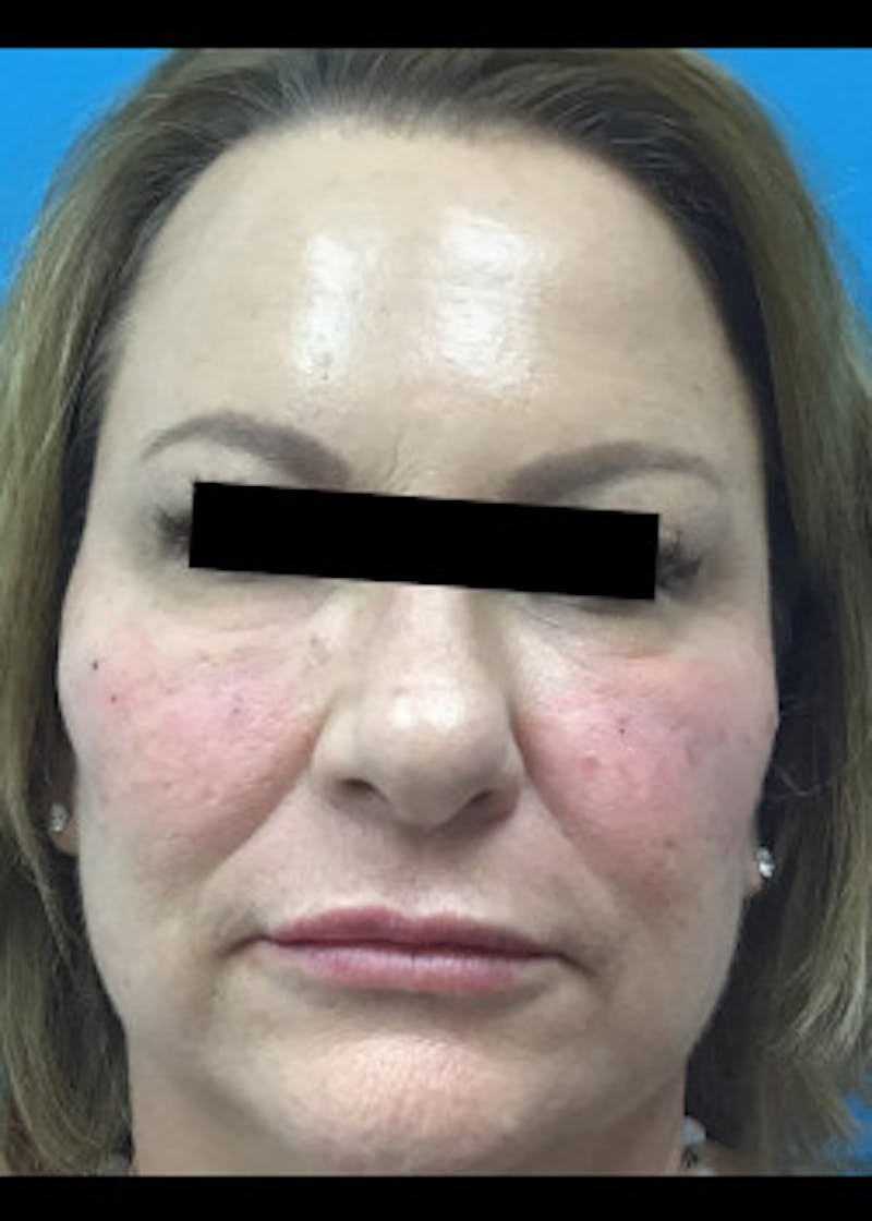 Fillers Before & After Gallery - Patient 46619870 - Image 4