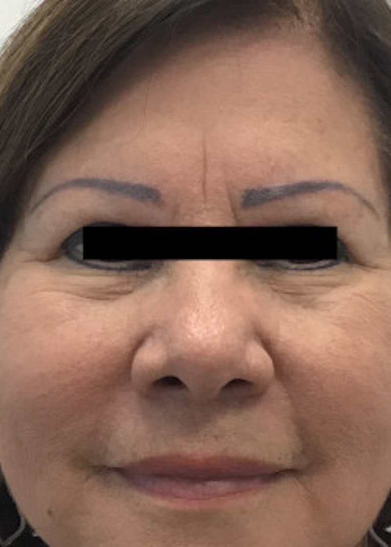 Fillers Before & After Gallery - Patient 46619906 - Image 1