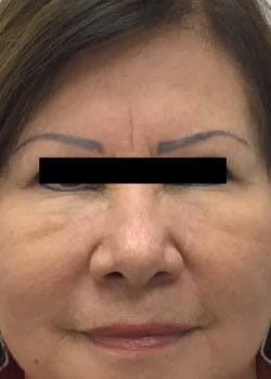 Before & After Photos of Botox in Friendswood & League City, TX