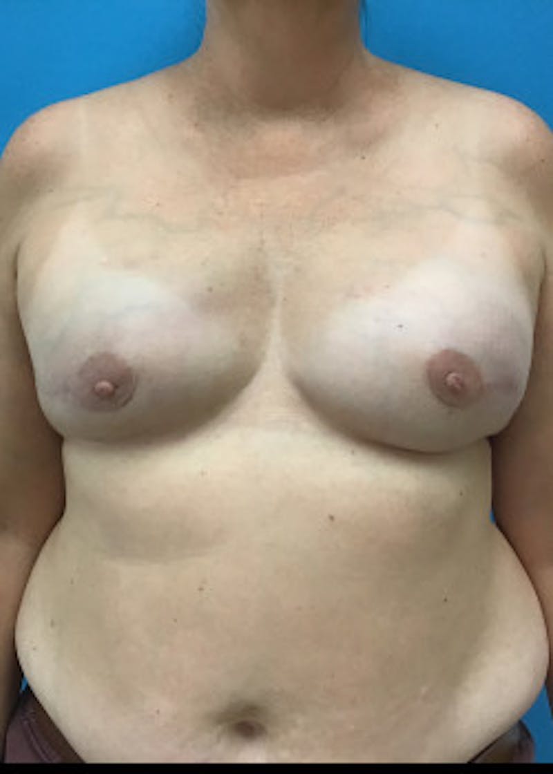 Breast Reconstruction Before & After Gallery - Patient 46620046 - Image 4