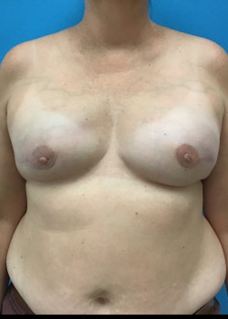 Breast Reconstruction Before & After Gallery - Patient 46620046 - Image 4
