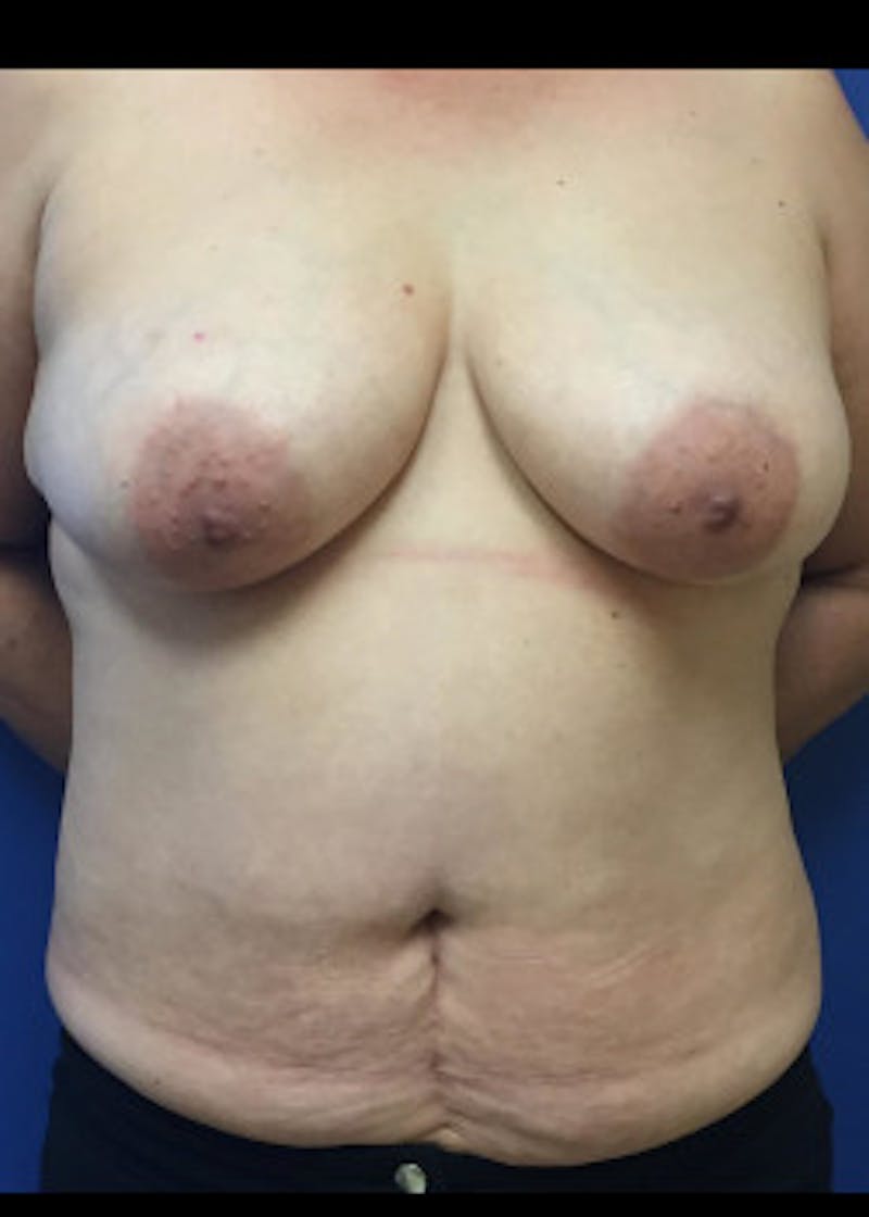 Breast Reconstruction Before & After Gallery - Patient 46620086 - Image 1