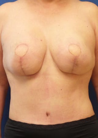Breast Reconstruction Before & After Gallery - Patient 46620086 - Image 2