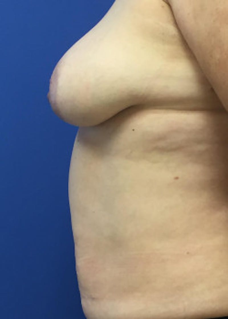 Breast Reconstruction Before & After Gallery - Patient 46620086 - Image 3