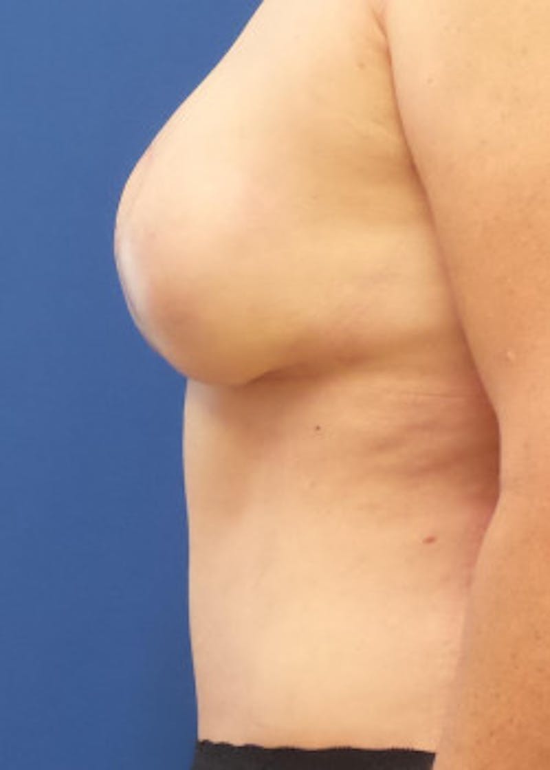 Breast Reconstruction Before & After Gallery - Patient 46620086 - Image 4