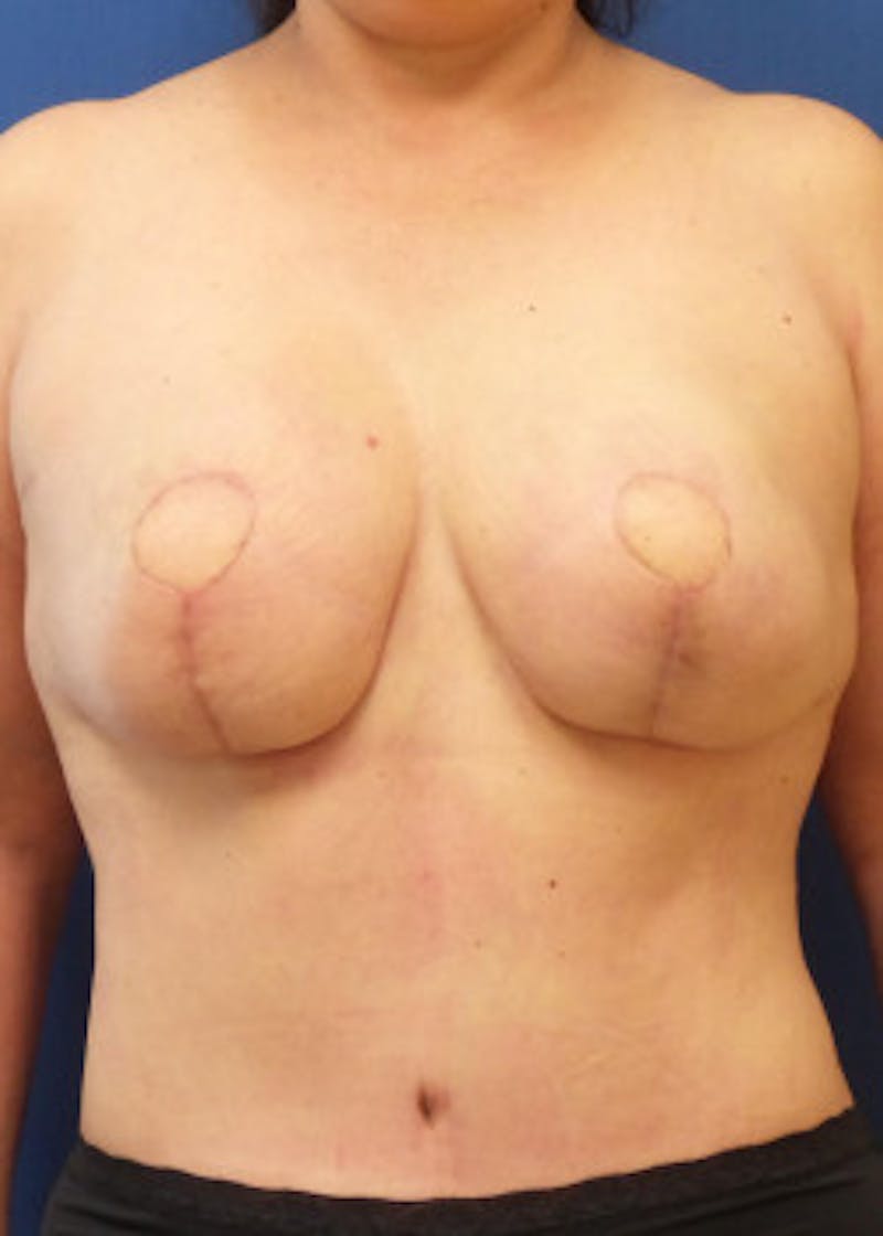 Breast Reconstruction Before & After Gallery - Patient 46620086 - Image 5