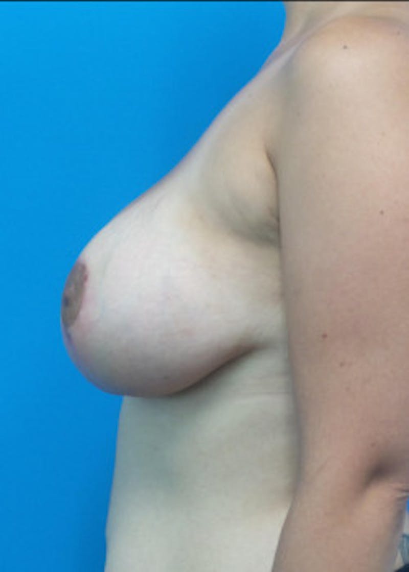 Breast Lift Before & After Gallery - Patient 46620236 - Image 4