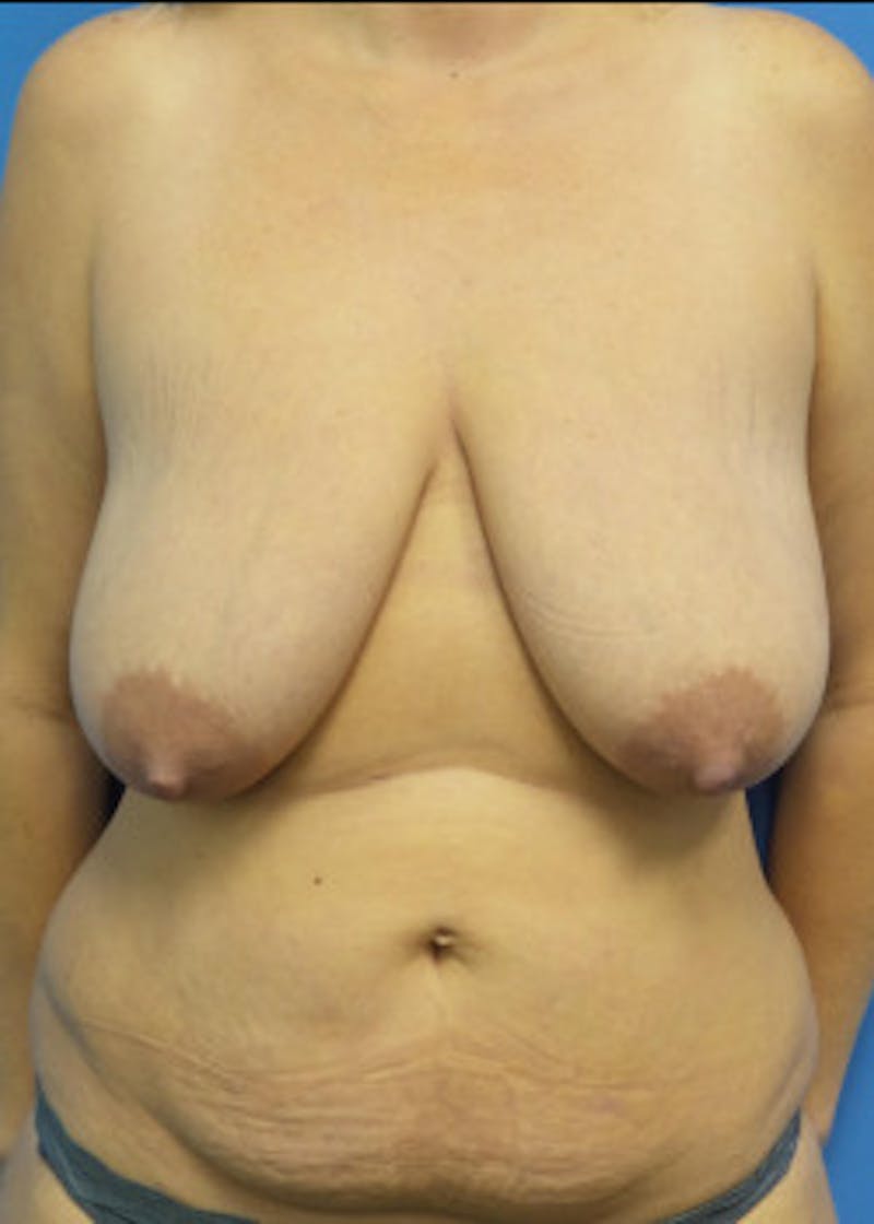 Breast Lift Before & After Gallery - Patient 46620263 - Image 1