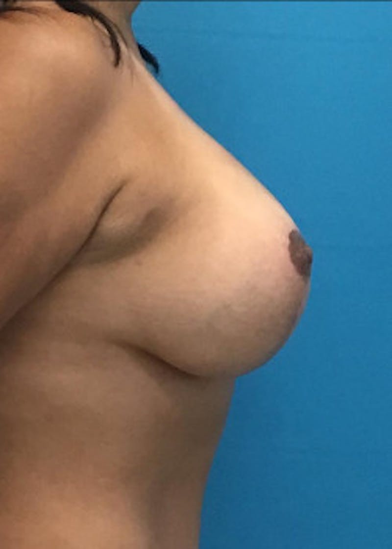 Breast Lift Before & After Gallery - Patient 46620335 - Image 4